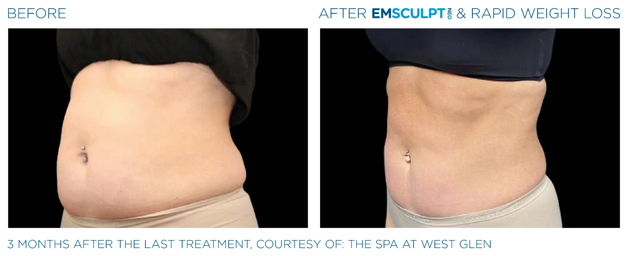 Before and after Emsculpt Neo treatment - 3 months results