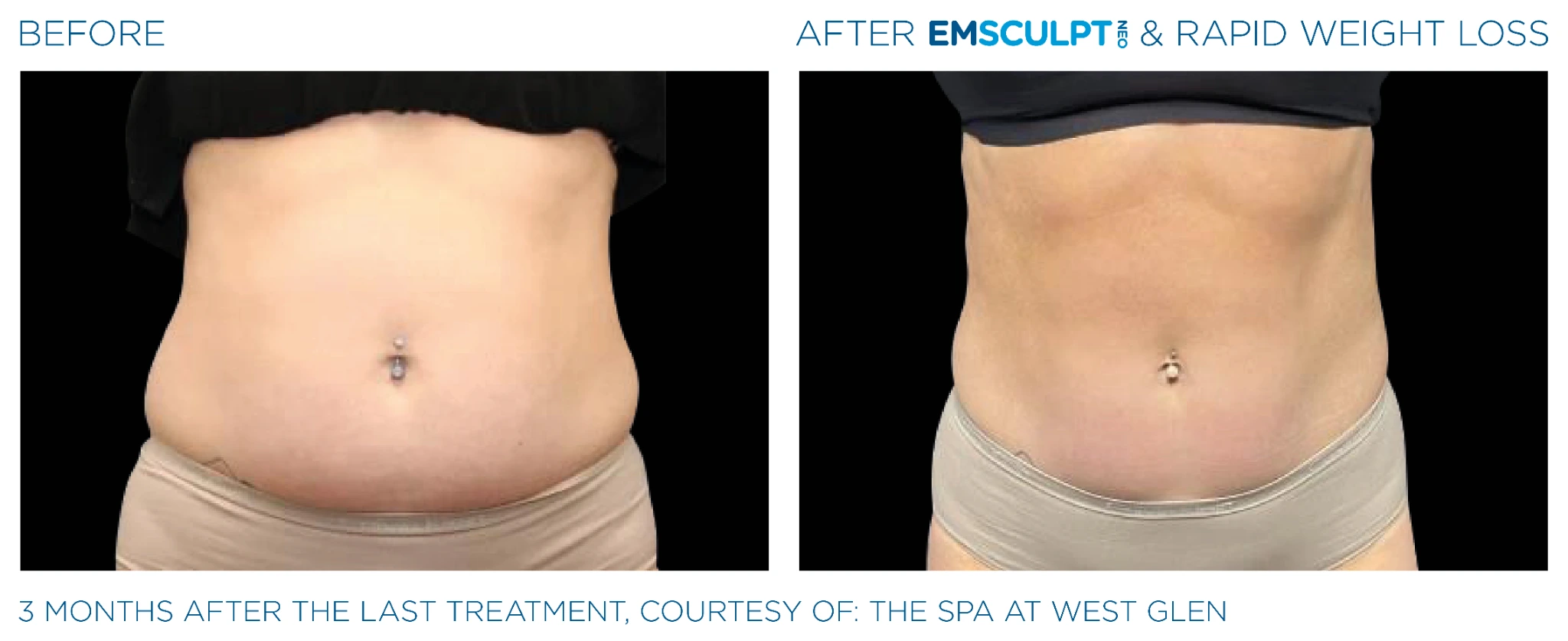 Before and after Emsculpt Neo treatment - 3 months results