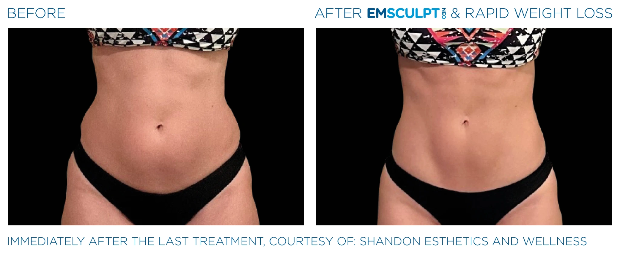 Before and after Emsculpt Neo treatment - immediate results