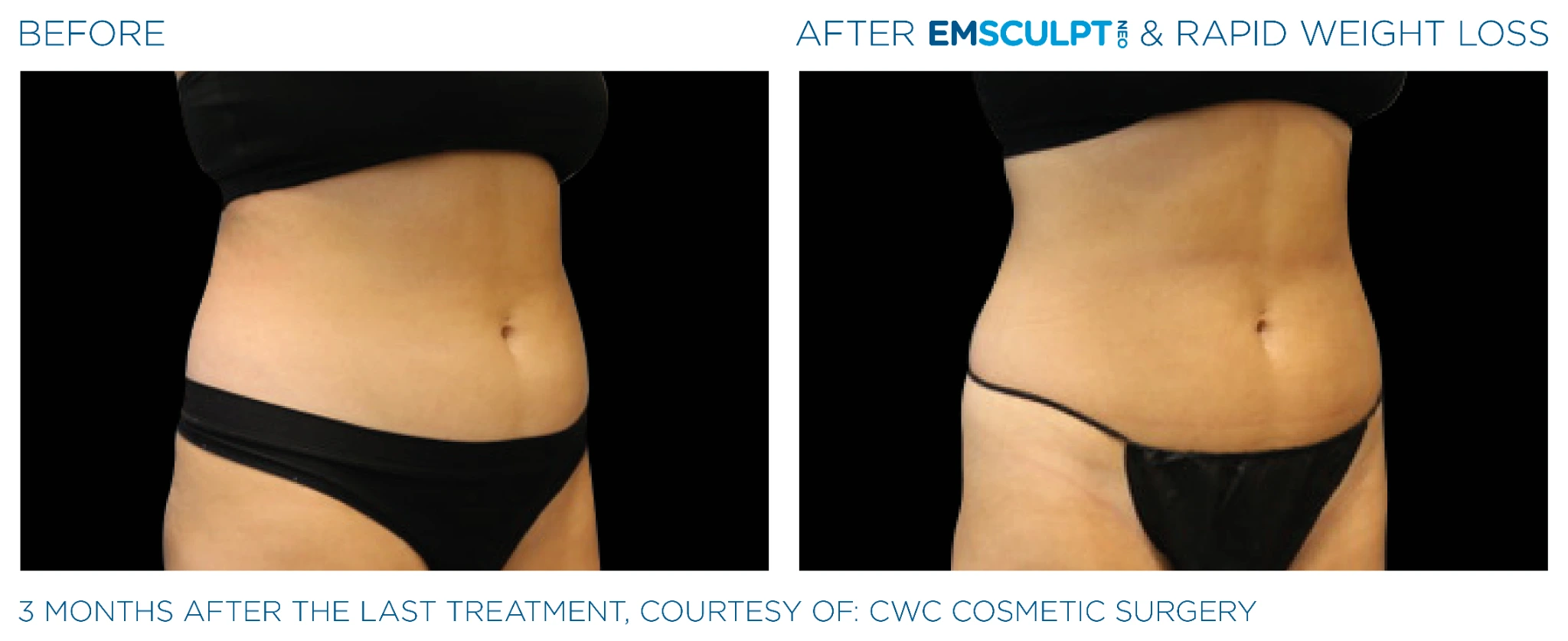 Before and after Emsculpt Neo treatment - 3 months results
