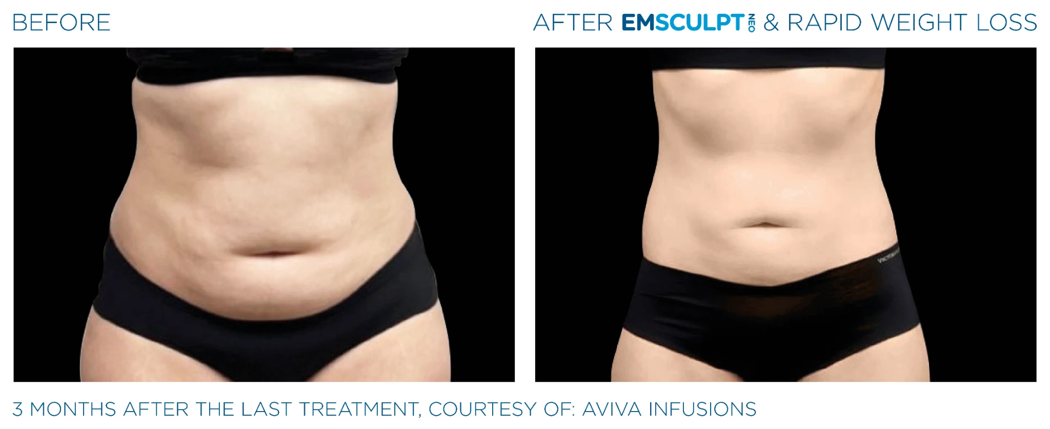 Before and after Emsculpt Neo treatment - 3 months results