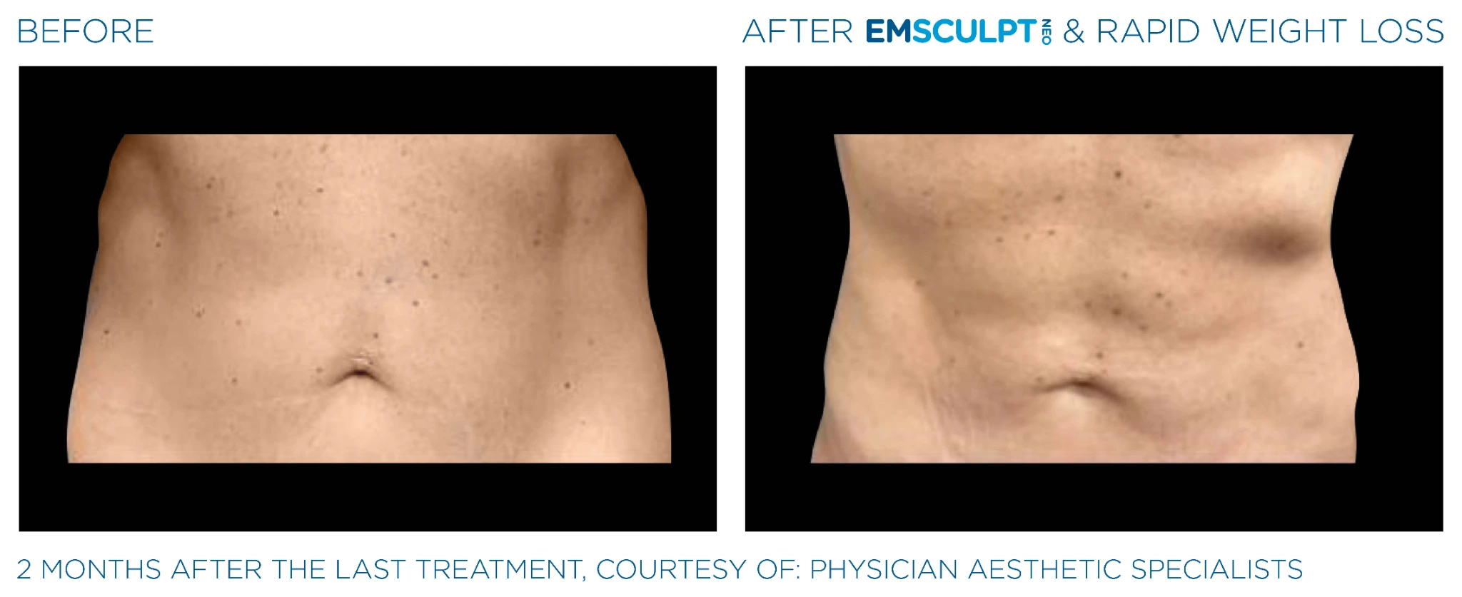 Before and after Emsculpt Neo treatment - 2 months results